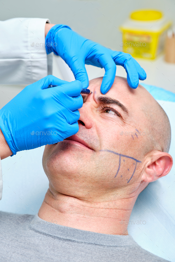 Marking The Face Of A Man With A Dermographic Pen For Treatment Of